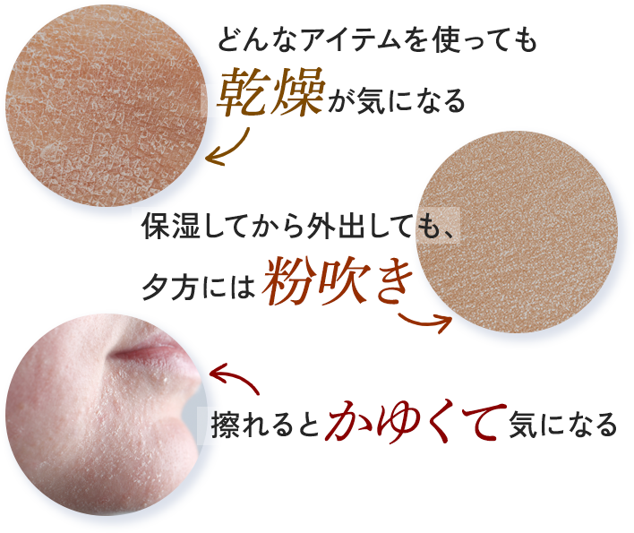 乾燥が気になる、夕方には粉ふき、痒くて気になる